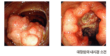 대장암의 내시경 소견