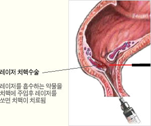 레이저 치핵수술