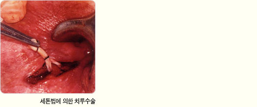 세톤법에 의한 치루수술