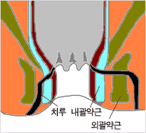 항문주위농양 관련 이미지 2