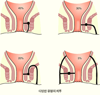 다양한 유형의 치루