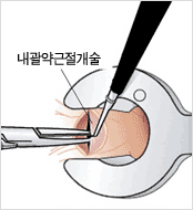 내괄약근절개술 관련 이미지